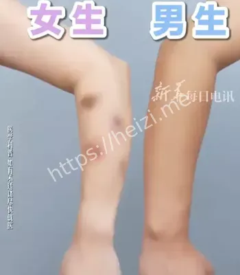 淤青体质